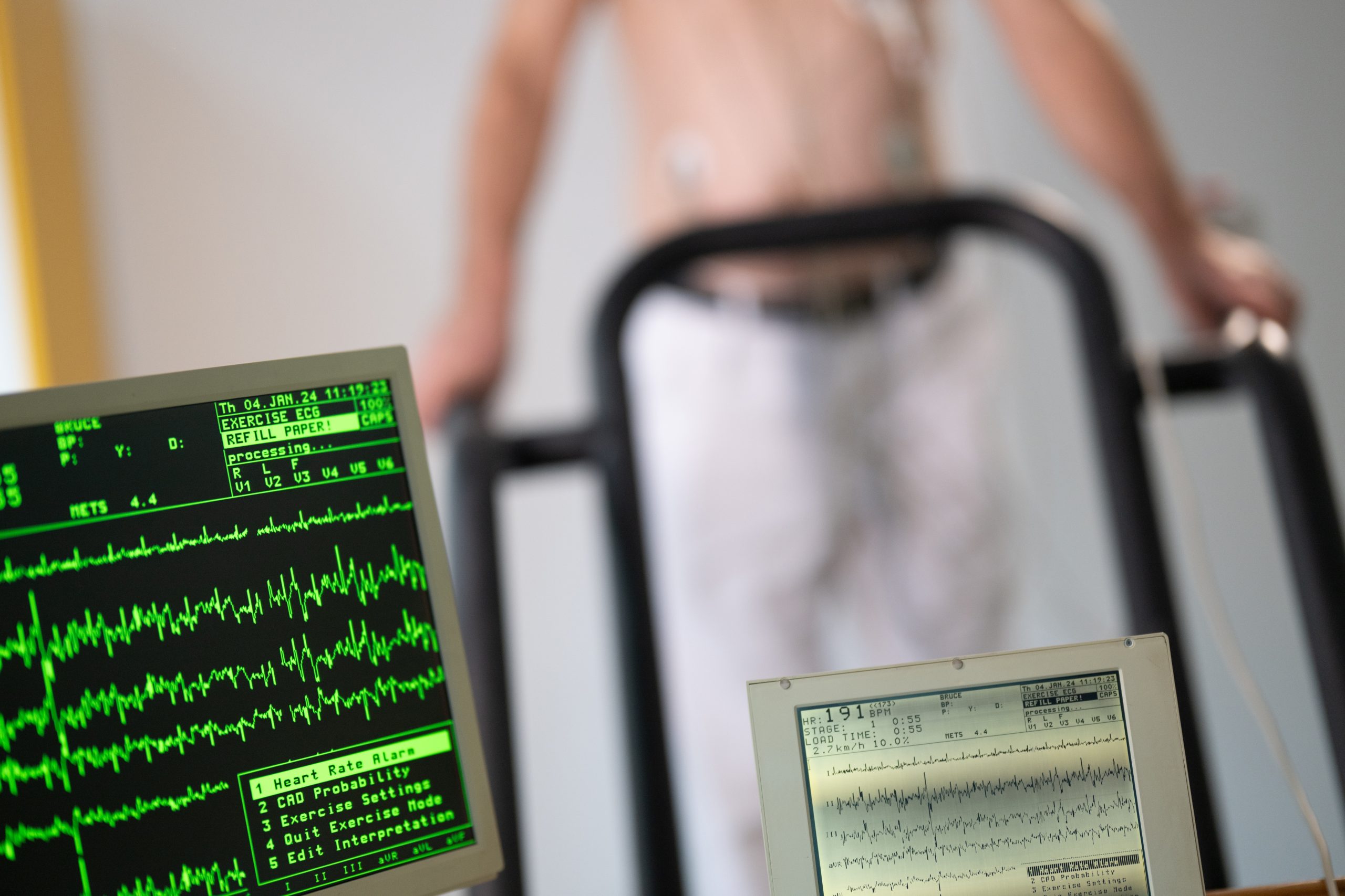 Exercise ECG (Stress Test) performed to assess heart function during physical activity