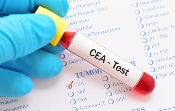 Medical illustration related to Carcinoembryonic Antigen (CEA), supporting patient education and health screening.