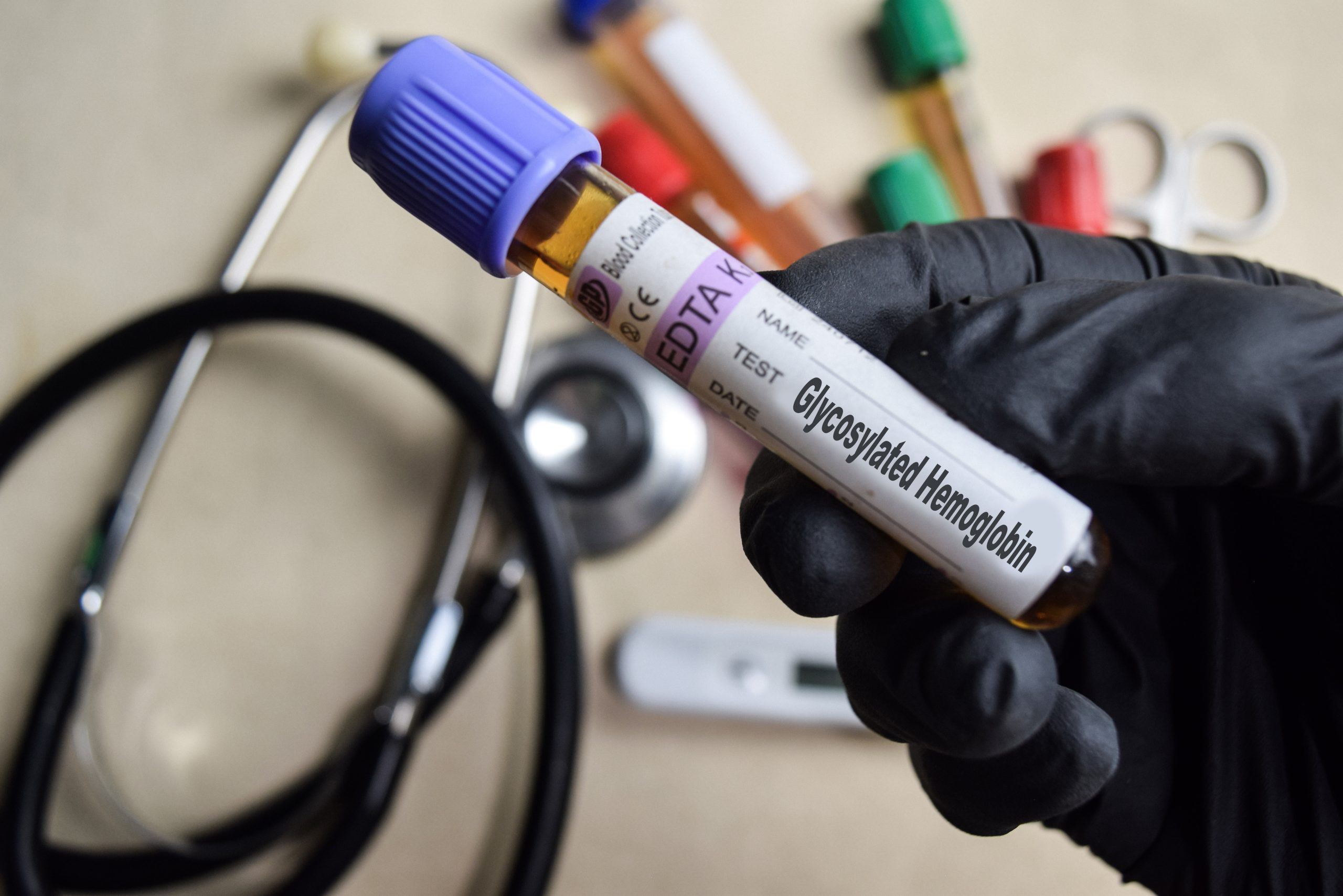 Blood sample tube labelled HbA1c (Glycosylated Haemoglobin) used to measure long-term blood sugar control and monitor diabetes at Evercare Medical Care Centre in Penang.