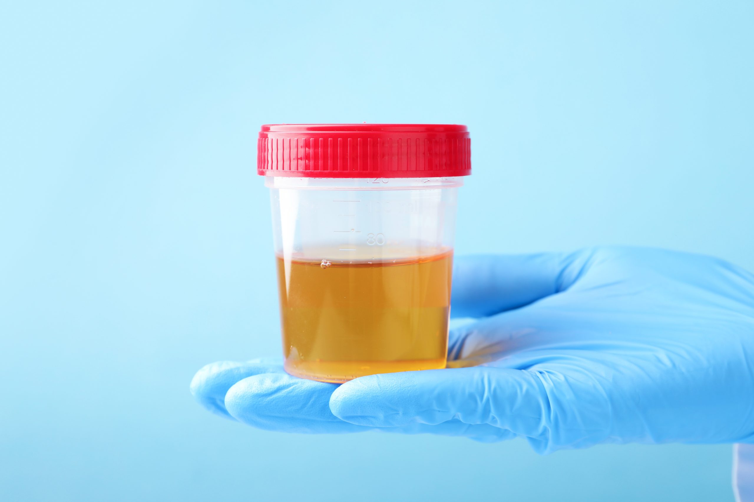 Medical illustration related to Urine FEME (Urine Full Examination and Microscopic Examination), supporting patient education and health screening.